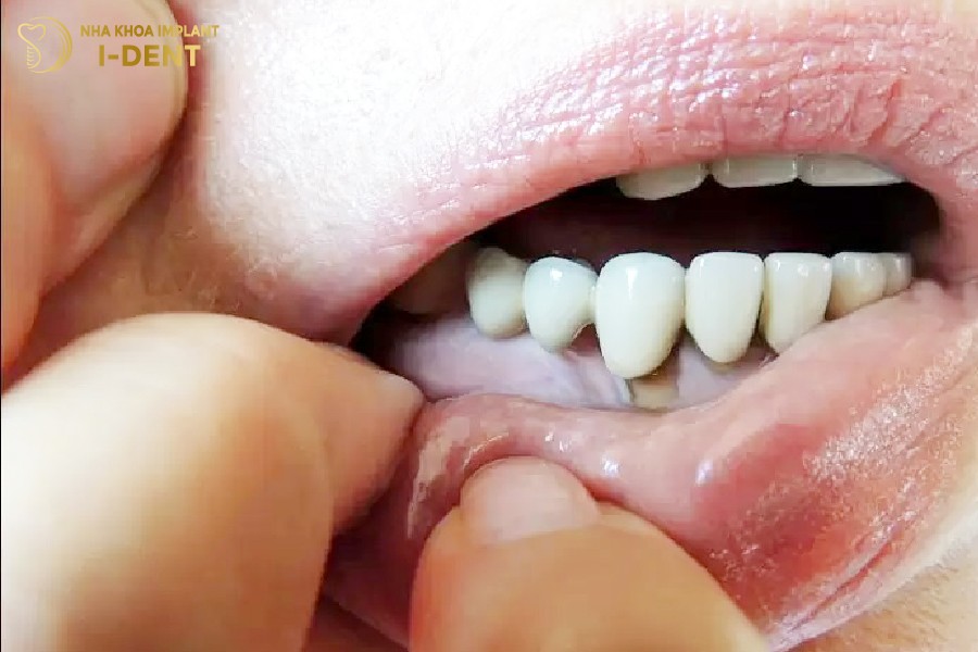 bọc răng sứ giá rẻ