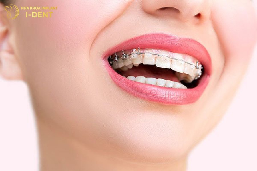 Niềng răng mắc cài pha lê đảm bảo thẩm mỹ khi nói cười