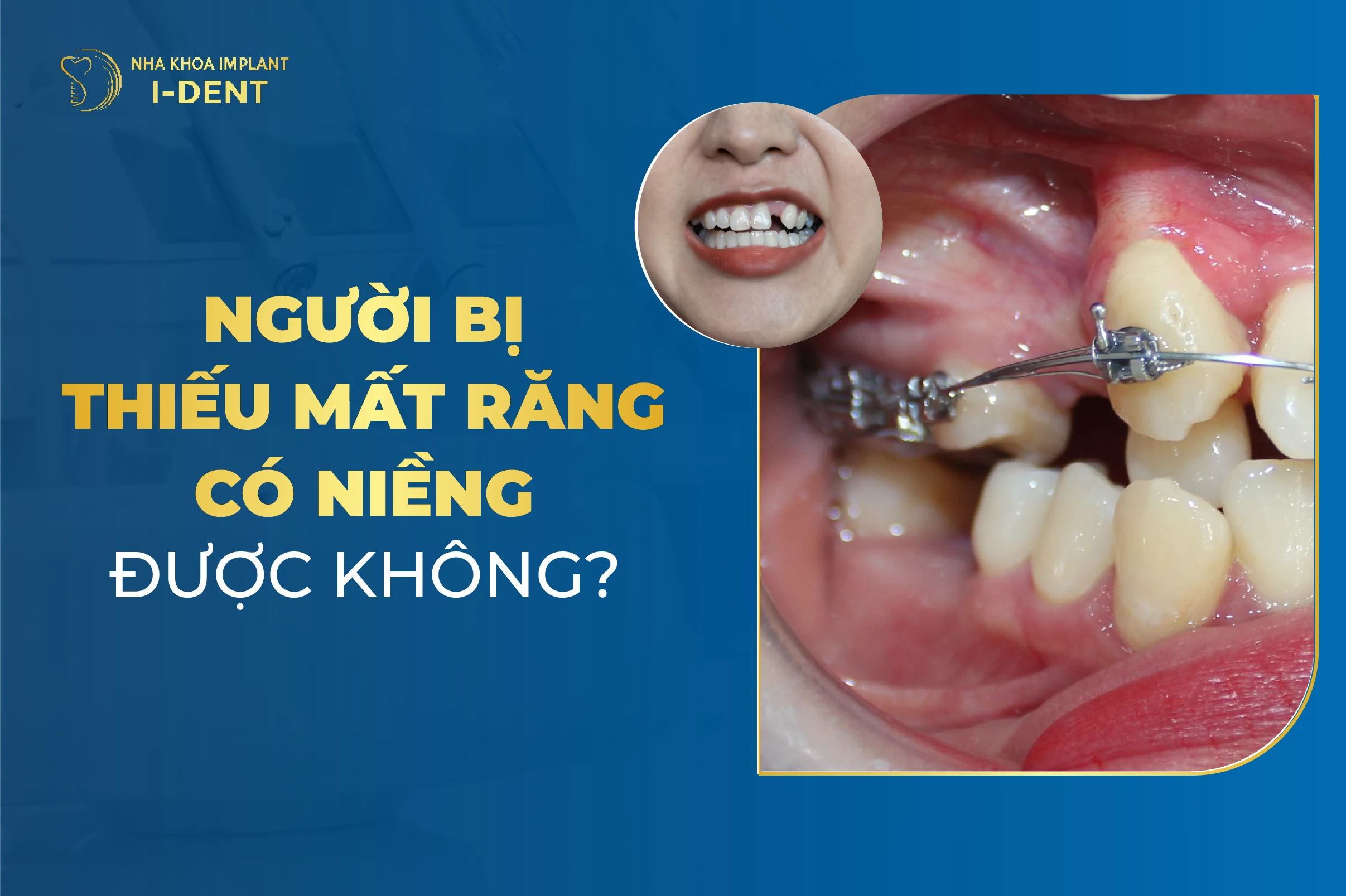 Người Bị Mất Răng Thì Có Niềng Được Không?