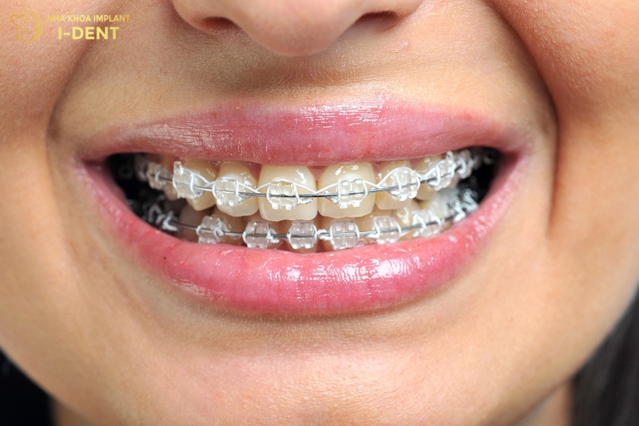 niềng răng mắc cài pha lê
