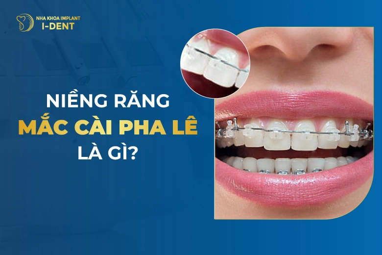 Niềng răng mắc cài pha lê là gì? Phân loại, giá và ưu điểm