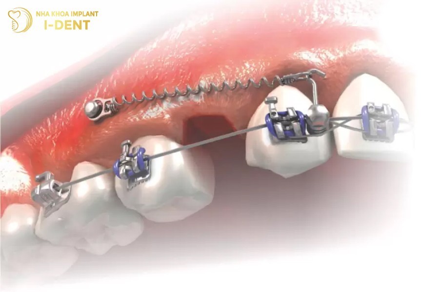 Đặt vít niềng răng hỗ trợ rút ngắn thời gian niềng răng