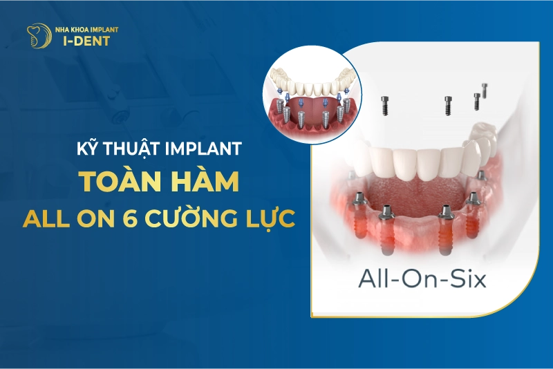 Kỹ thuật implant toàn hàm all-on-6 cường lực cao cấp