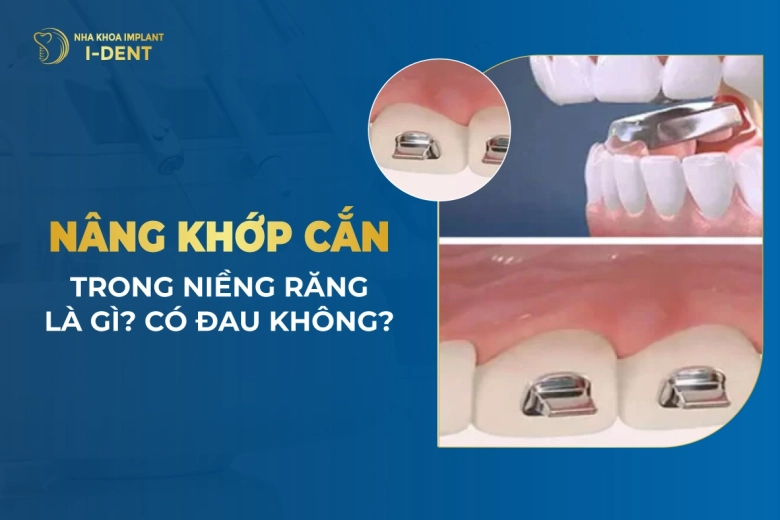 Nâng khớp cắn trong niềng răng là gì? Có tác dụng gì?