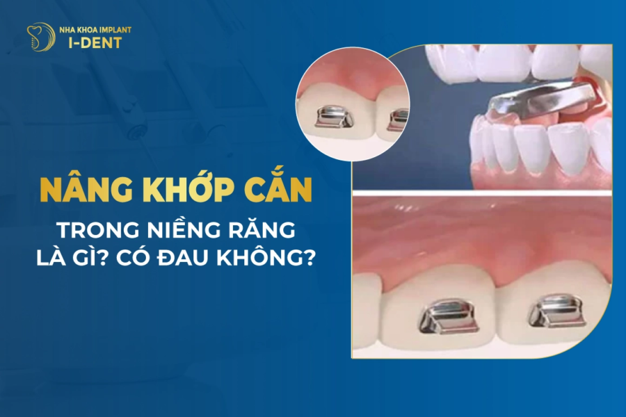 Nâng khớp cắn trong niềng răng là gì? Có tác dụng gì?