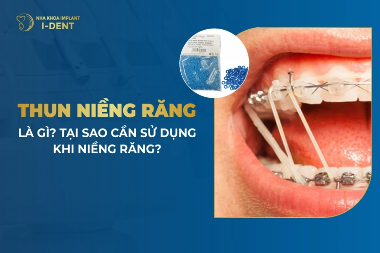 Đeo dây thun niềng răng có tác dụng gì? Phân loại thun niềng