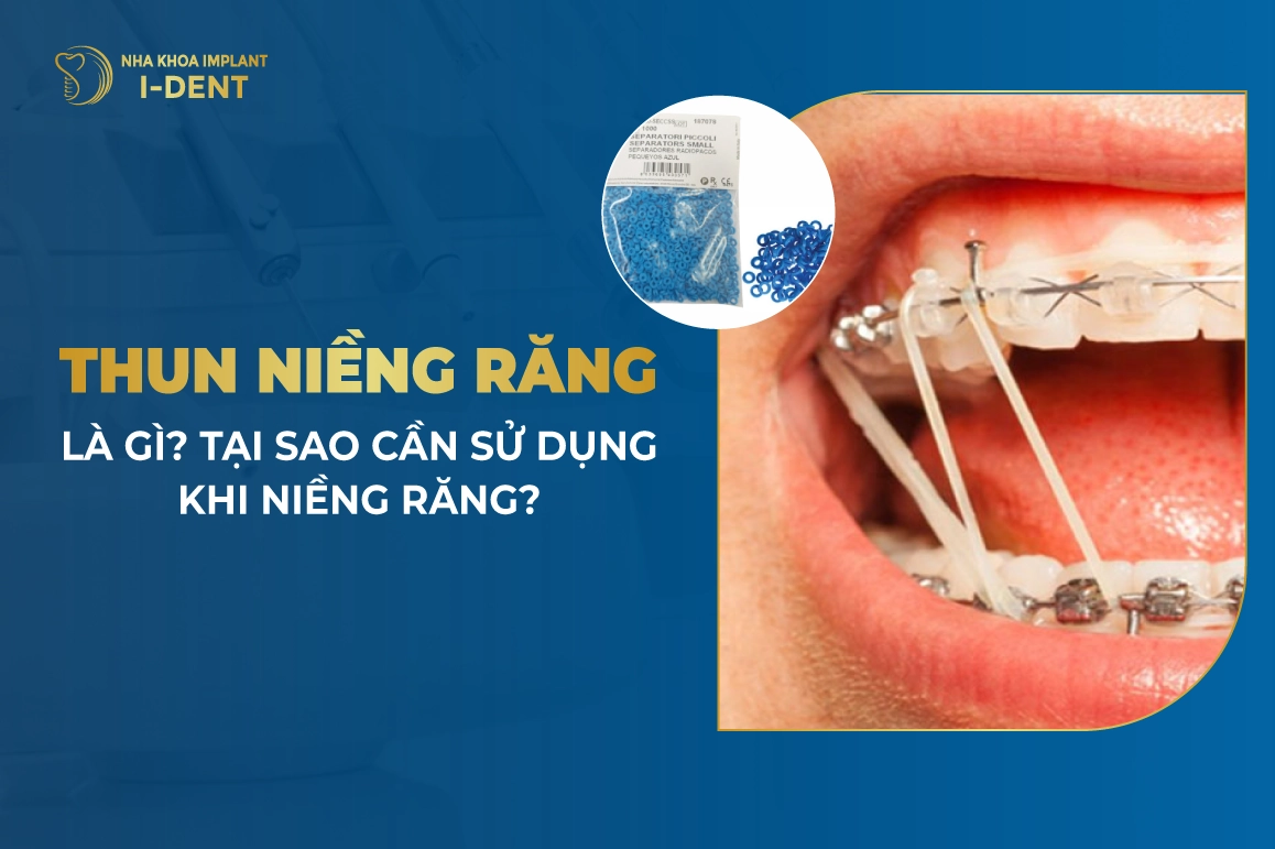 Đeo dây thun niềng răng có tác dụng gì? Phân loại thun niềng