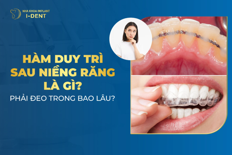 Hàm duy trì sau niềng răng có mấy loại? Đeo trong bao lâu? Giá