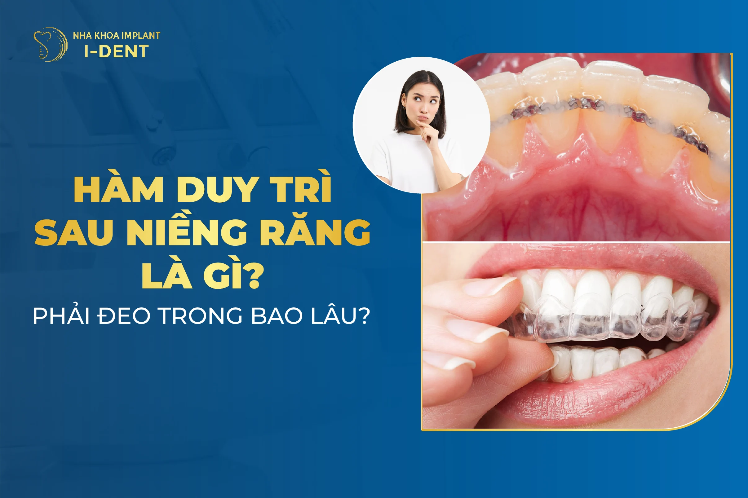 Hàm duy trì sau niềng răng có mấy loại? Đeo trong bao lâu? Giá