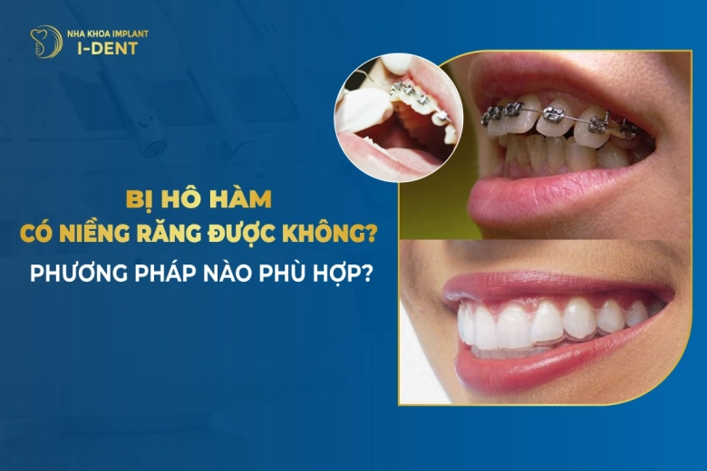 Hô hàm trêm có niềng răng được không? Vì sao?