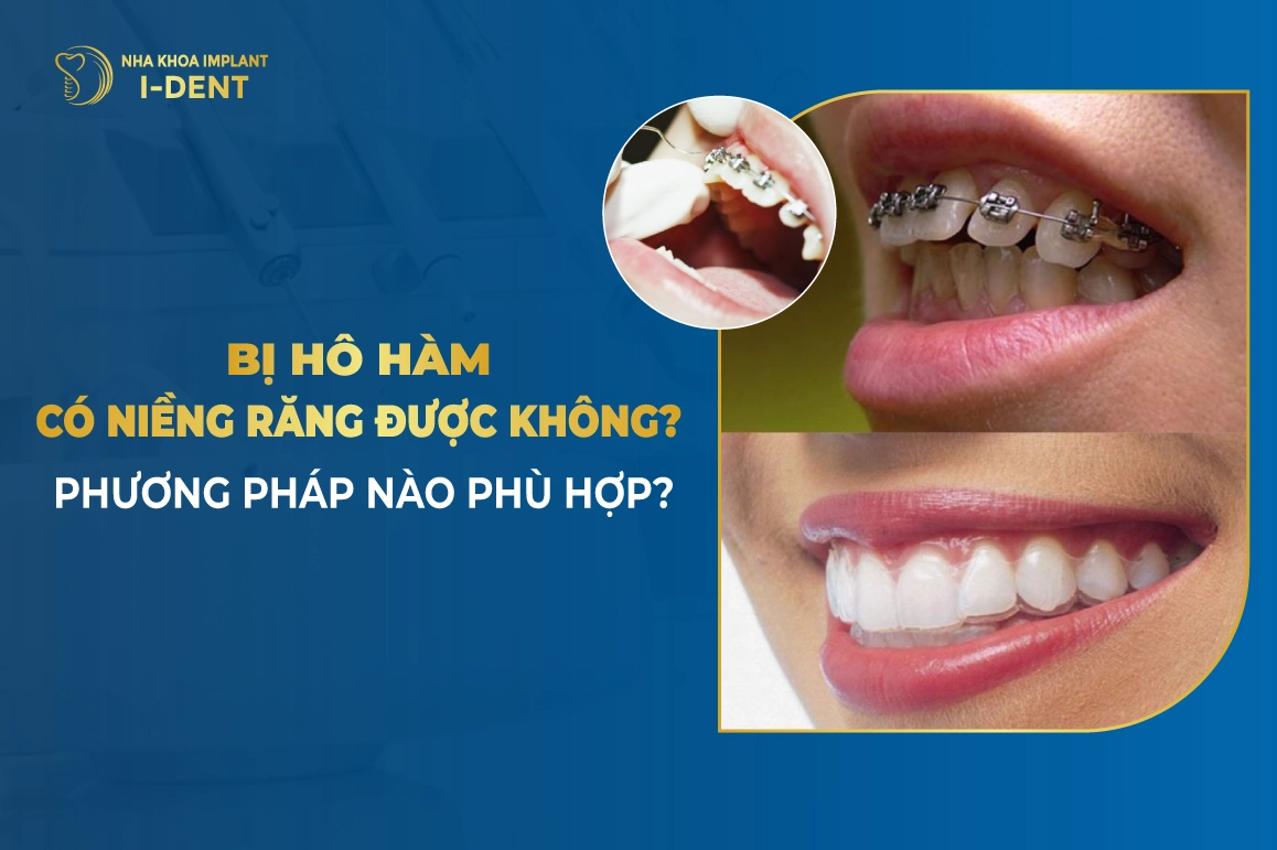 Hô hàm trêm có niềng răng được không? Vì sao?