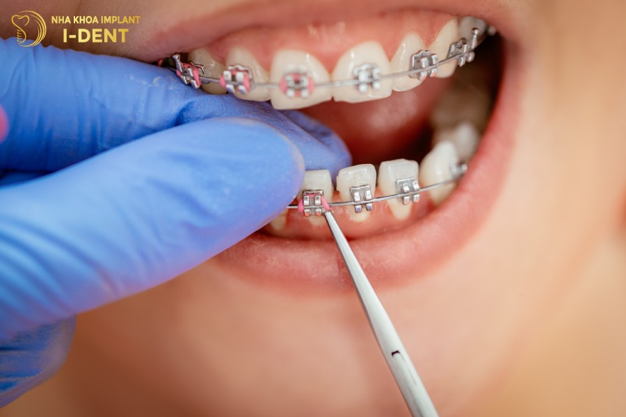 niềng răng có bị tụt lợi không