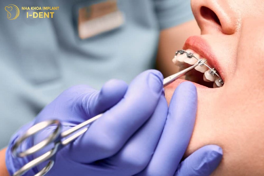 Niềng răng cần tái khám đúng lịch hẹn của bác sĩ
