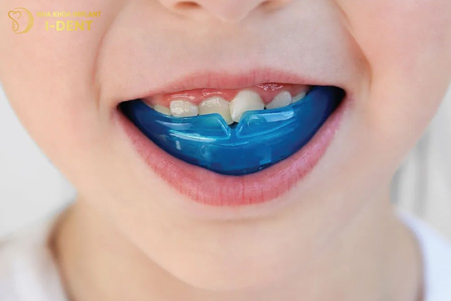 máng niềng răng cho trẻ em