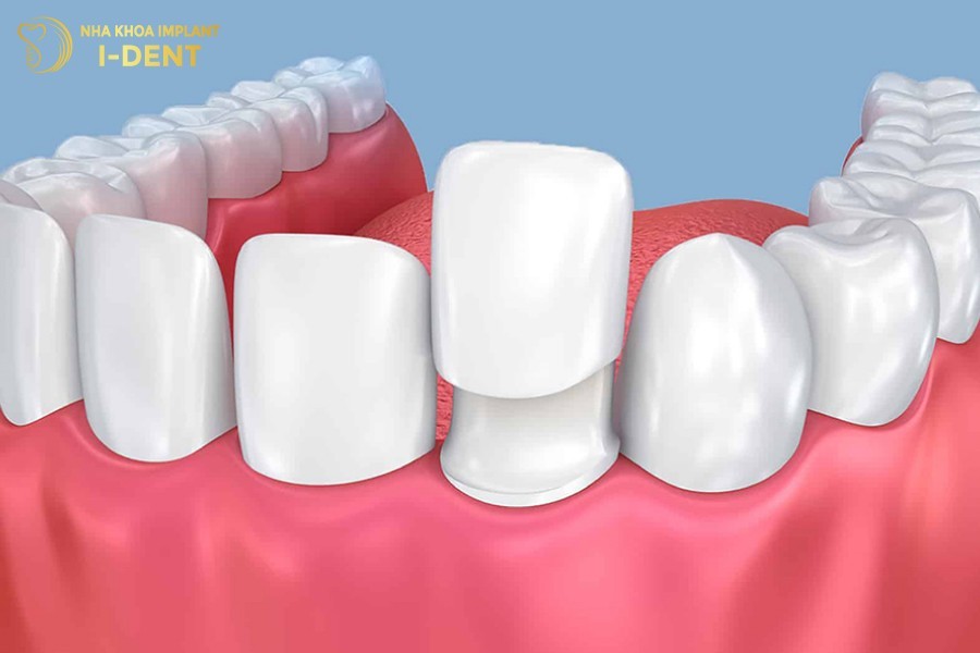 bị sâu răng có niềng răng được không