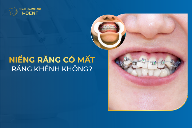 Niềng răng có mất răng khểnh không? Có cần nhổ răng khểnh không?