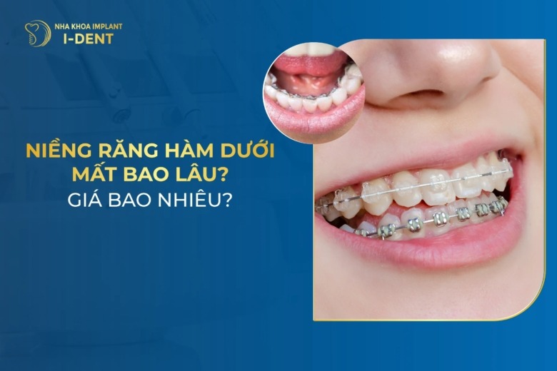 Niềng răng hàm dưới có được không? Mất bao lâu?