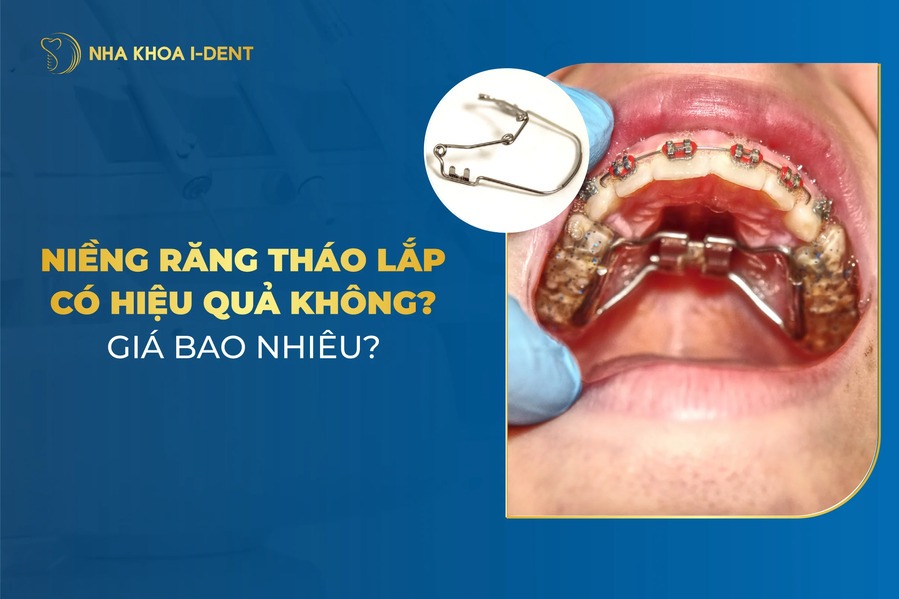 Niềng Răng Tháo Lắp Có Hiệu Quả Không?