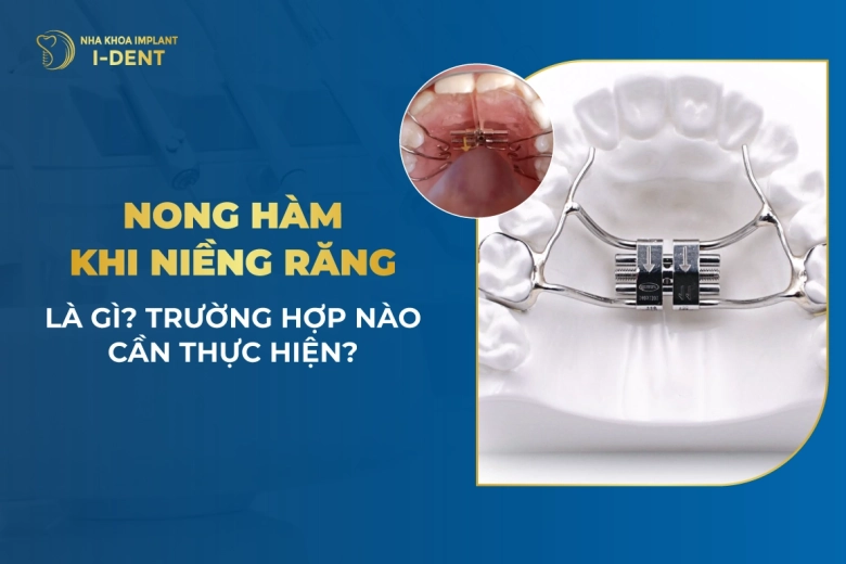 Vừa nong hàm vừa niềng răng là gì? Trường hợp cần nào thực hiện?