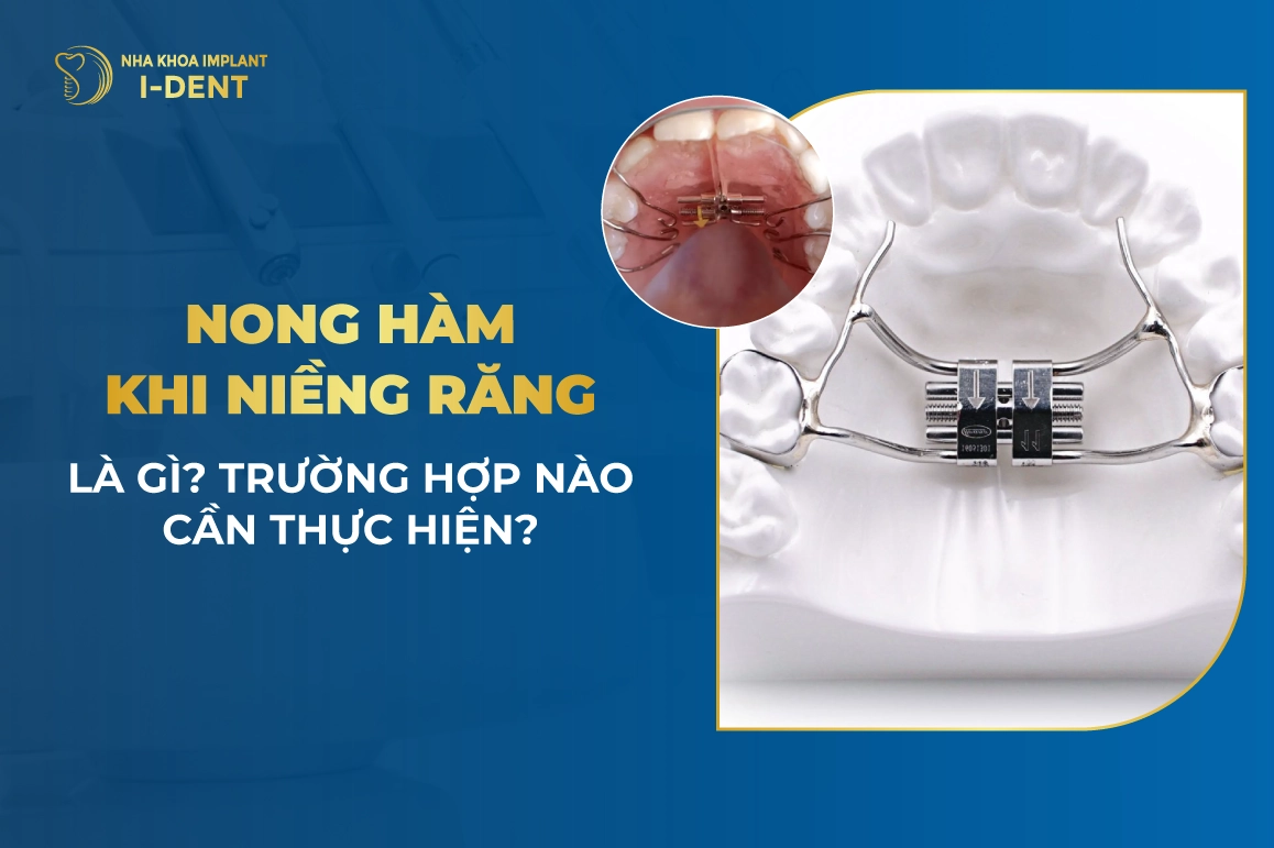 Vừa nong hàm vừa niềng răng là gì? Trường hợp cần nào thực hiện?