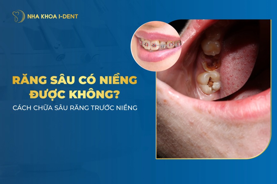 Đang Bị Sâu Răng Có Niềng Được Không? Cách Trị Sâu Răng