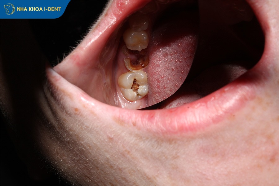 răng sâu nhiều có niềng được không