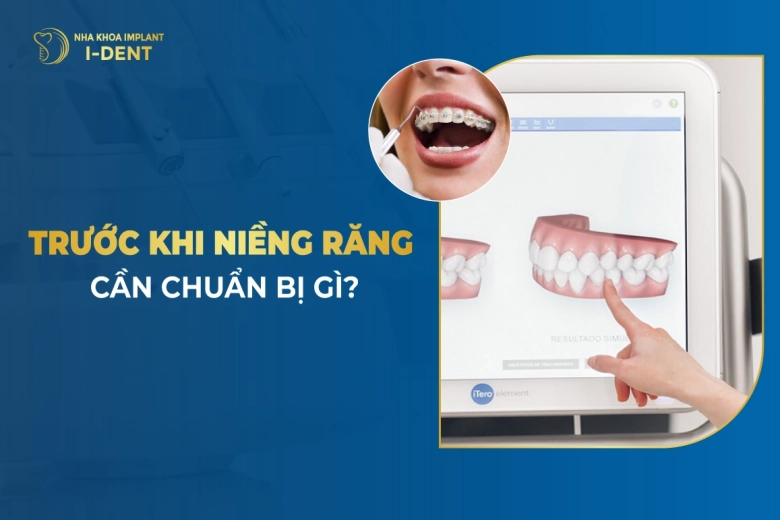Những điều cần biết và chuẩn bị trước khi niềng răng