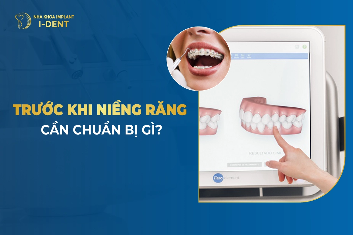 Những điều cần biết và chuẩn bị trước khi niềng răng