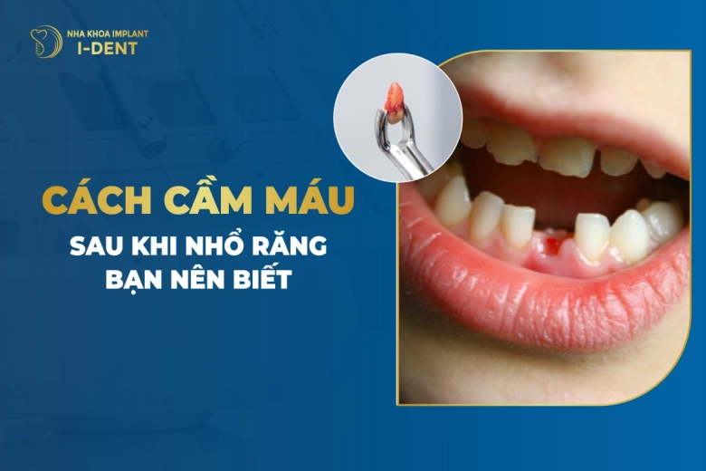 8 Cách cầm máu sau khi nhổ răng để lành thương nhanh
