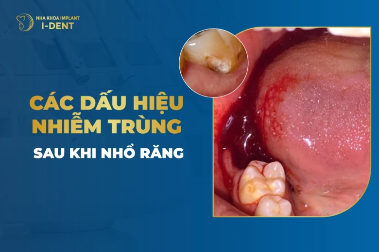 13 dấu hiệu nhiễm trùng sau khi nhổ răng và cách điều trị