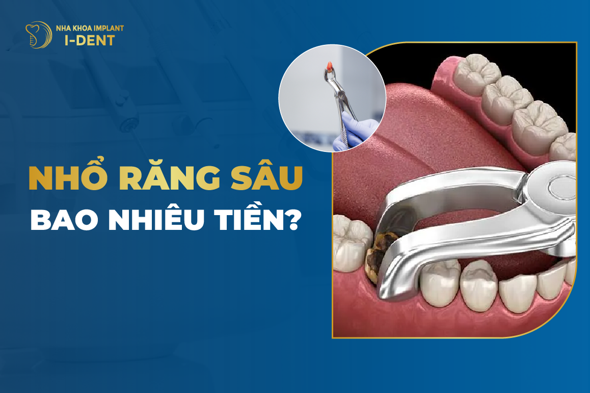 Bảng giá nhổ răng sâu 2026: Chi phí từng loại răng