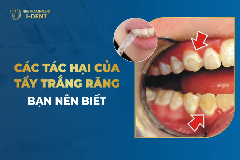 7 tác hại của tẩy trắng răng: Cần hiểu đúng trước khi làm