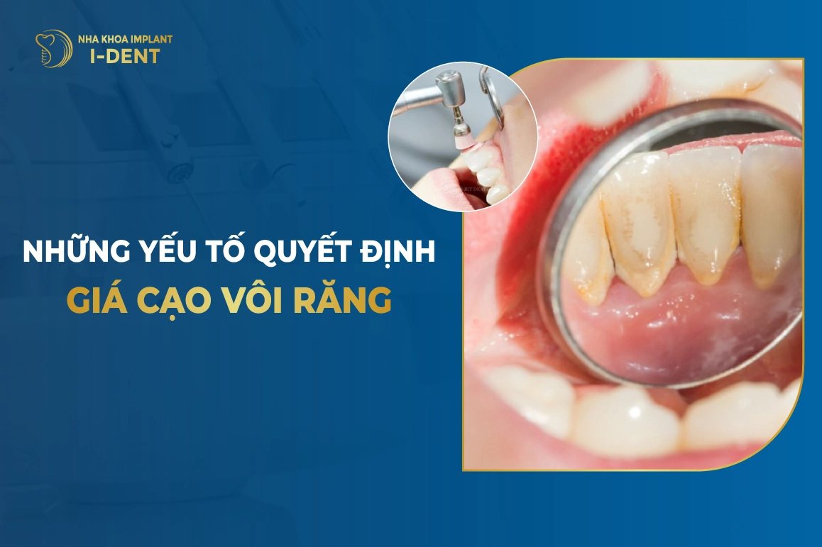 Chi phí lấy cao răng: Bảng giá 2026 và các yếu tố ảnh hưởng