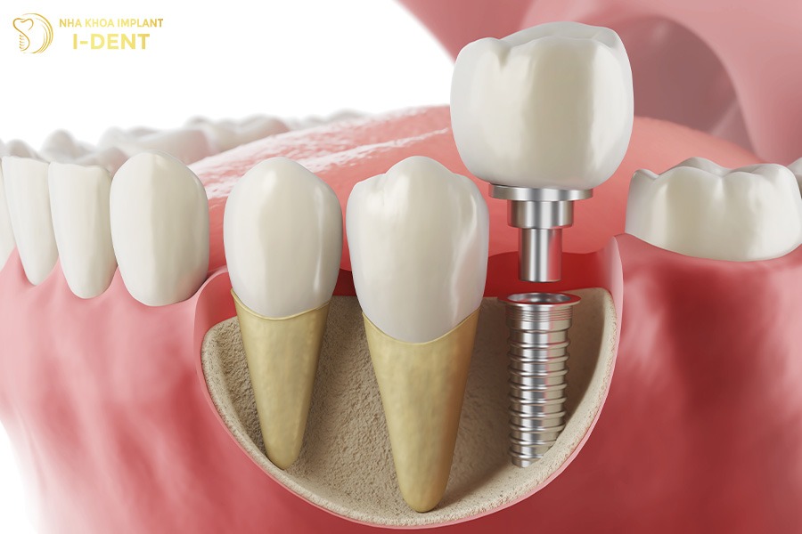 implant