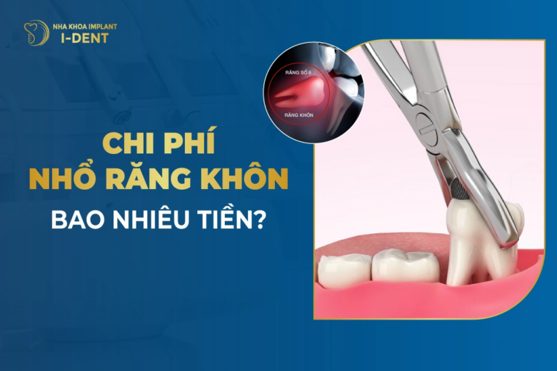 Bảng giá nhổ răng khôn 2026 mới nhất theo từng trường hợp