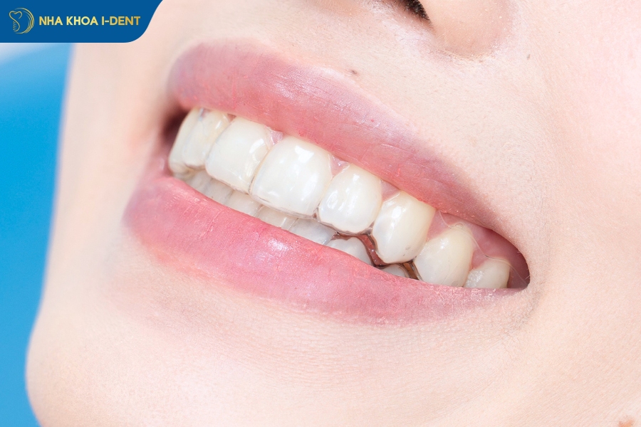 khay invisalign