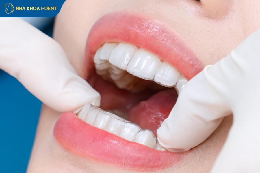 invisalign