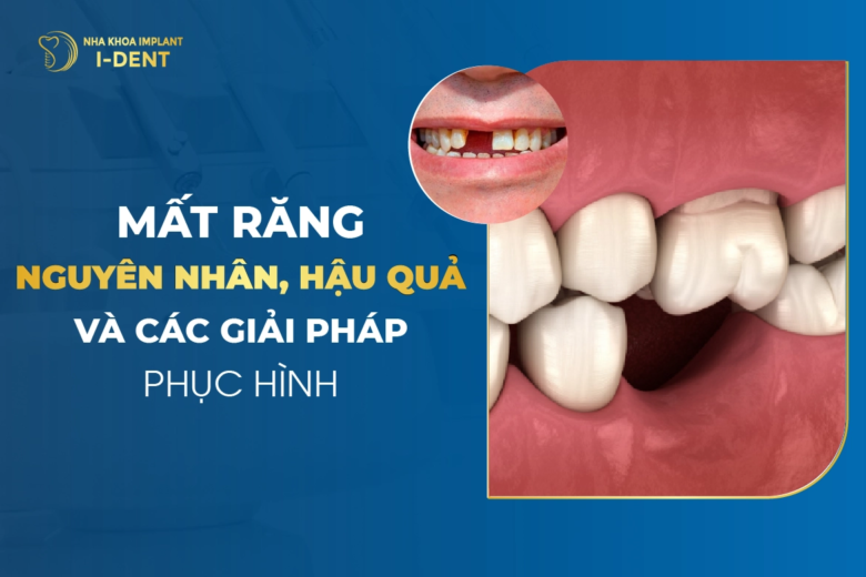Mất răng: Nguyên nhân, hậu quả và cách khắc phục