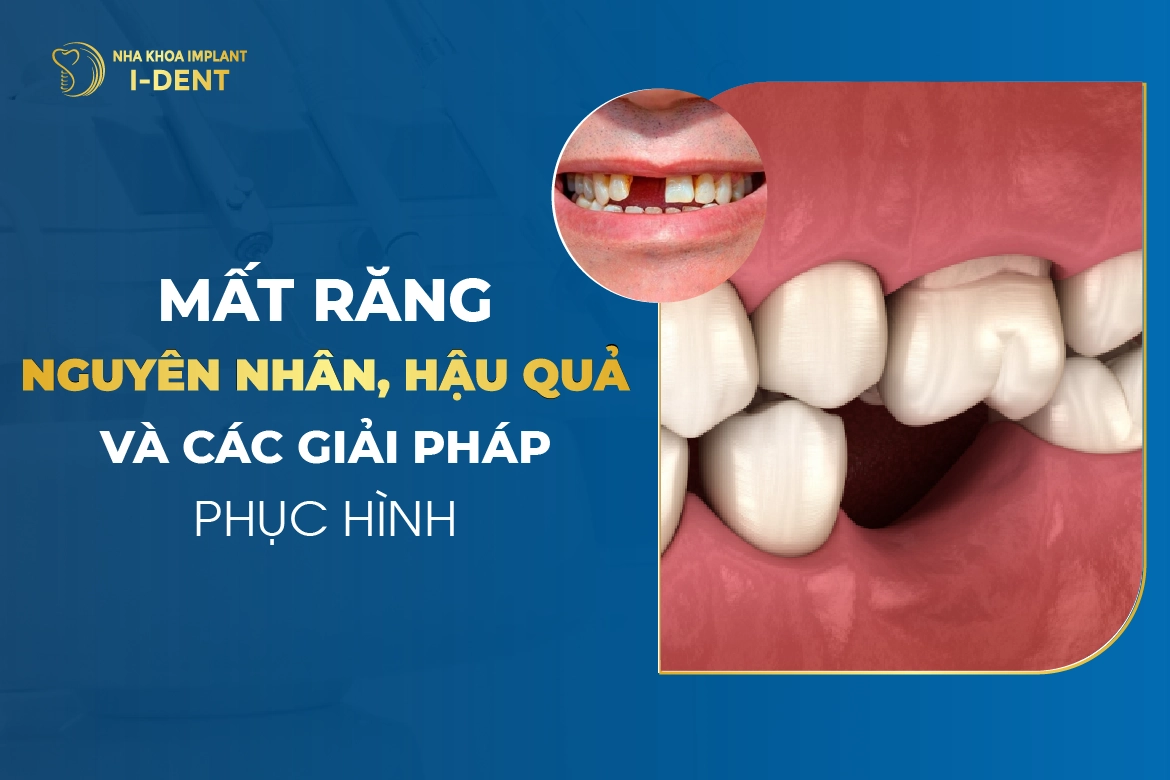 Mất răng: Nguyên nhân, hậu quả và cách khắc phục