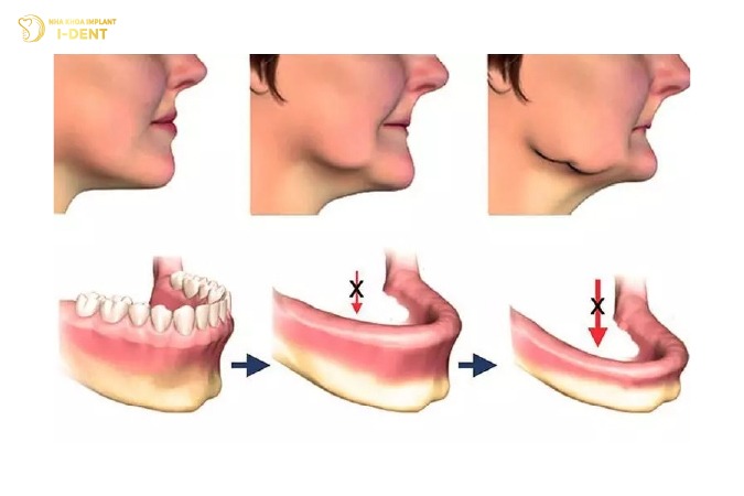 Mất răng toàn hàm khiến xương hàm bị tiêu và gương mặt già đi nhanh chóng Mất răng toàn hàm khiến xương hàm bị tiêu và gương mặt già đi nhanh chóng