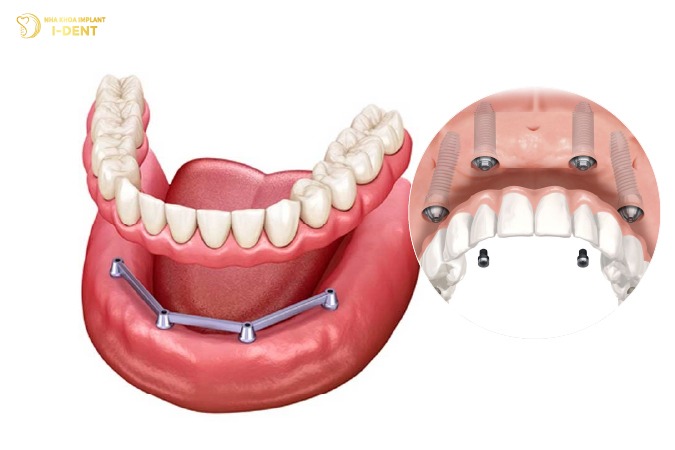 Phương pháp làm hàm phủ trên Implant Phương pháp làm hàm phủ trên Implant