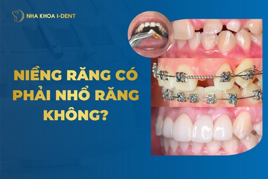 Niềng Răng Có Phải Nhổ Răng Không?