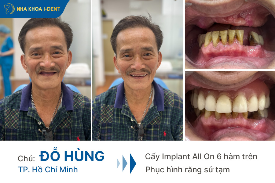 review trồng răng implant - Nha khoa I-Dent