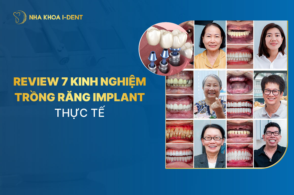 Review trồng răng implant: 7 Kinh nghiệm thực tế và giá
