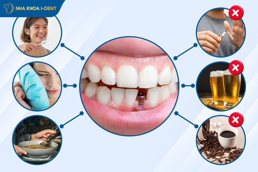 tuân thủ hướng dẫn của bác sĩ trước và sau khi cấy ghép implant