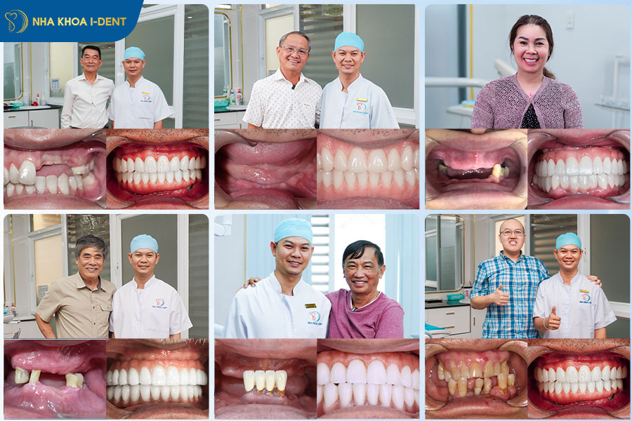 các loại trụ implant mỹ