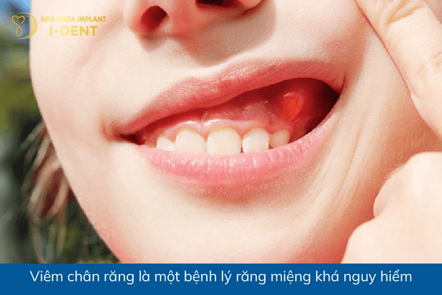 Viêm chân răng là một bệnh lý răng miệng khá nguy hiểm chan rang co chuc nang gi