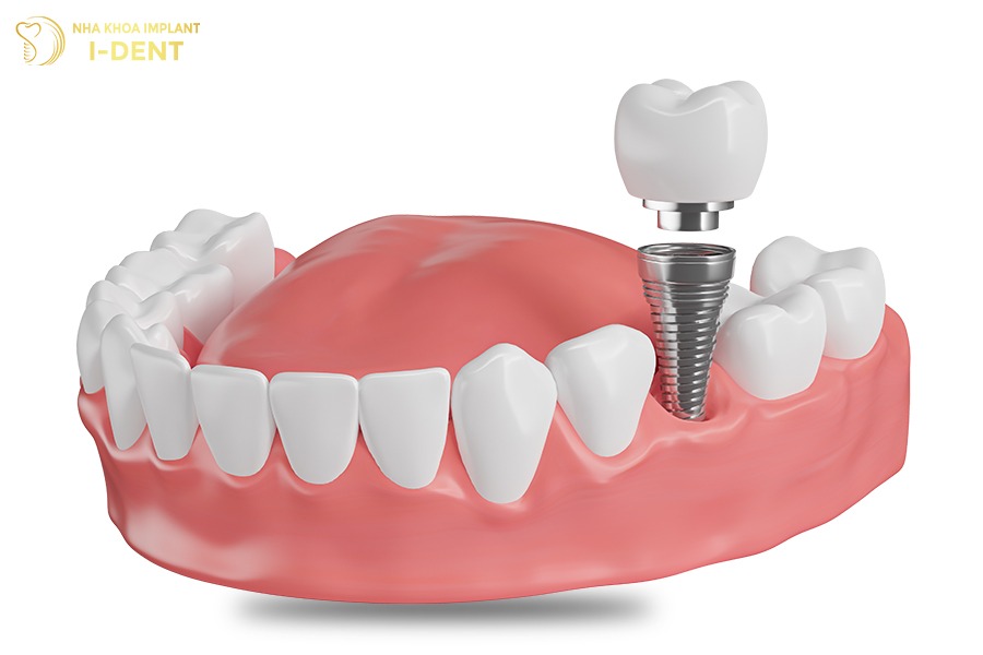 Trồng răng hàm bị sâu bằng phương pháp cấy ghép implant Trồng răng hàm bị sâu bằng phương pháp cấy ghép implant