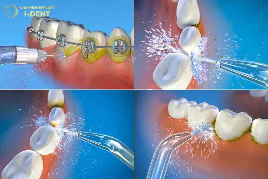 Công dụng của máy tăm nước Cách sử dụng tăm nước