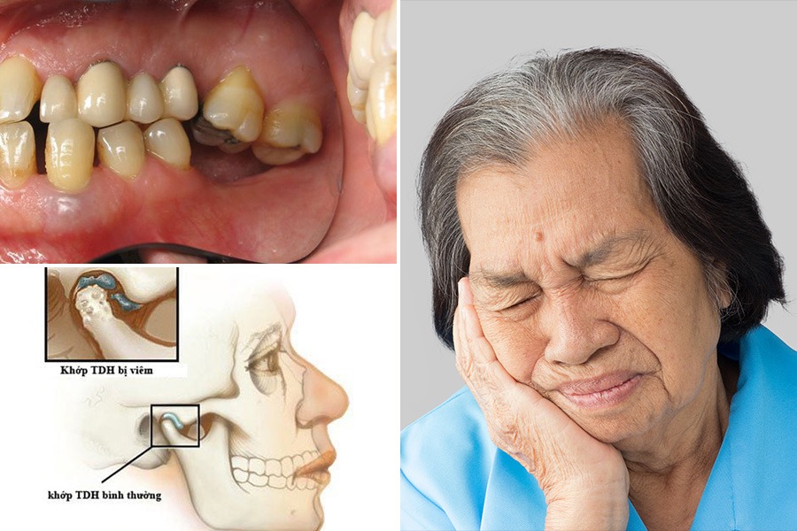 Mất răng hàm gây xô lệch răng, đau nhức khớp thái dương hàm Mất răng hàm có làm hóp má không
